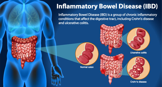 IBD is Inflammatory Bowel Disease